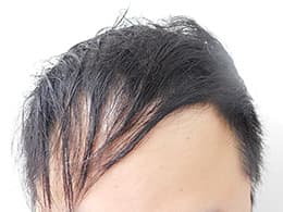 治療前